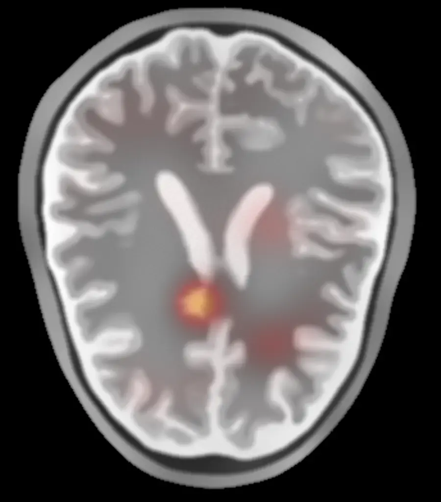 Reconstructed brain slice with the suspected stroke lesion highlighted in red on anatomy