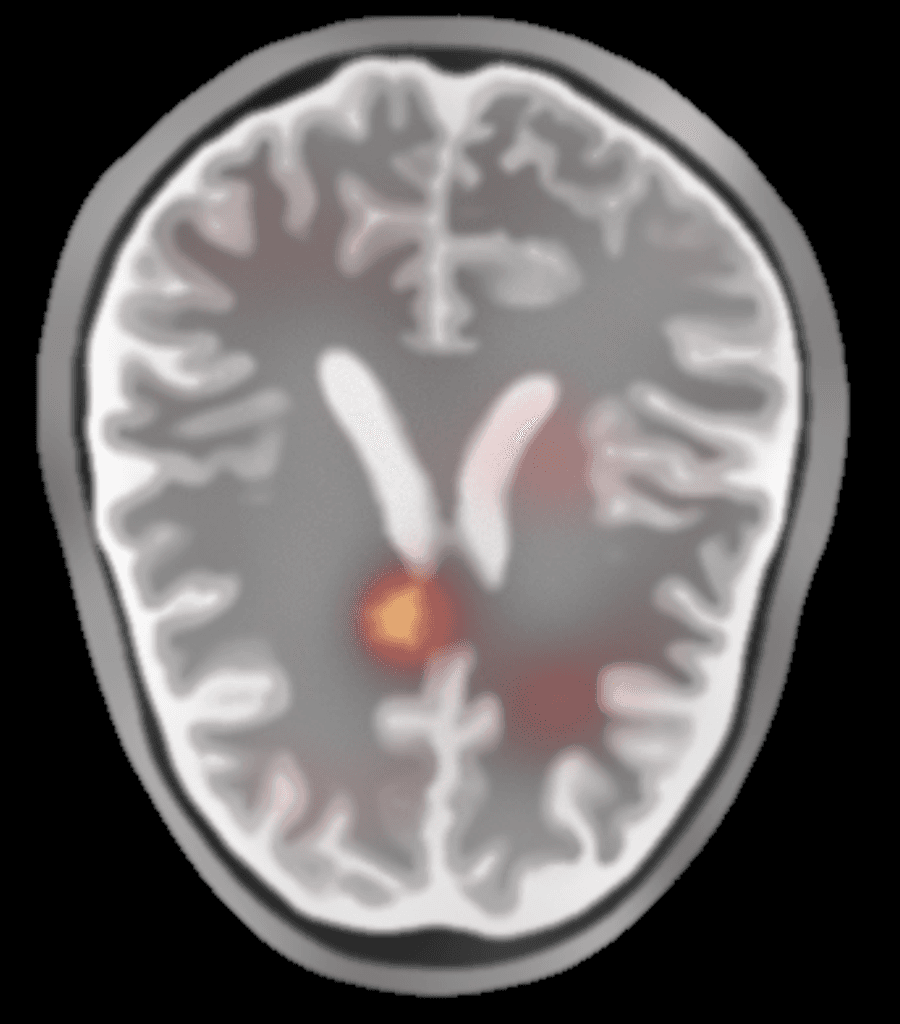 Reconstructed brain slice with the suspected stroke lesion highlighted in red on anatomy